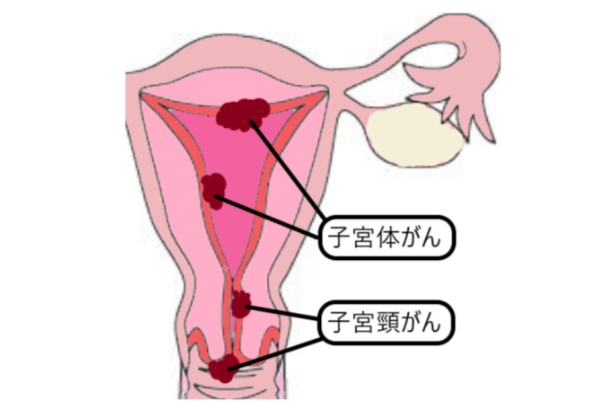 子宮がん検診