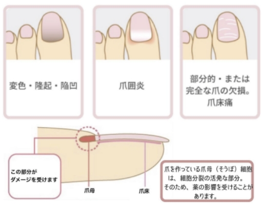 がん治療による爪の変化・変色