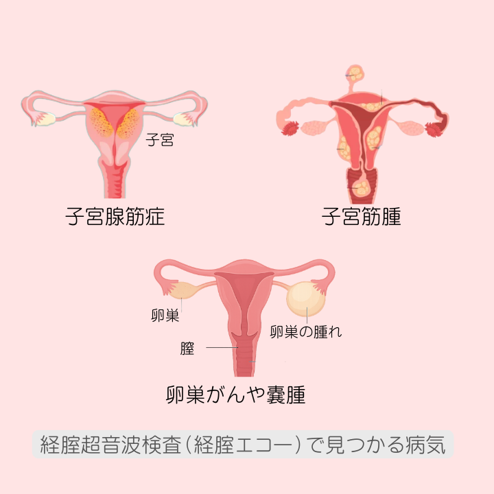 子宮がん検診・経腟エコー比較図｜横浜・山下公園｜みなと横浜ウイメンズクリニック